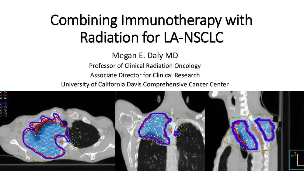 Combining Immunotherapy with Radiation for LA-NSCLC